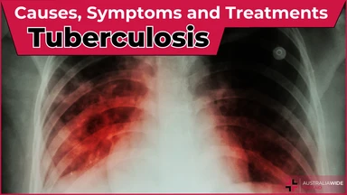 Tuberculosis article header – First Aid Article in Maroochydore